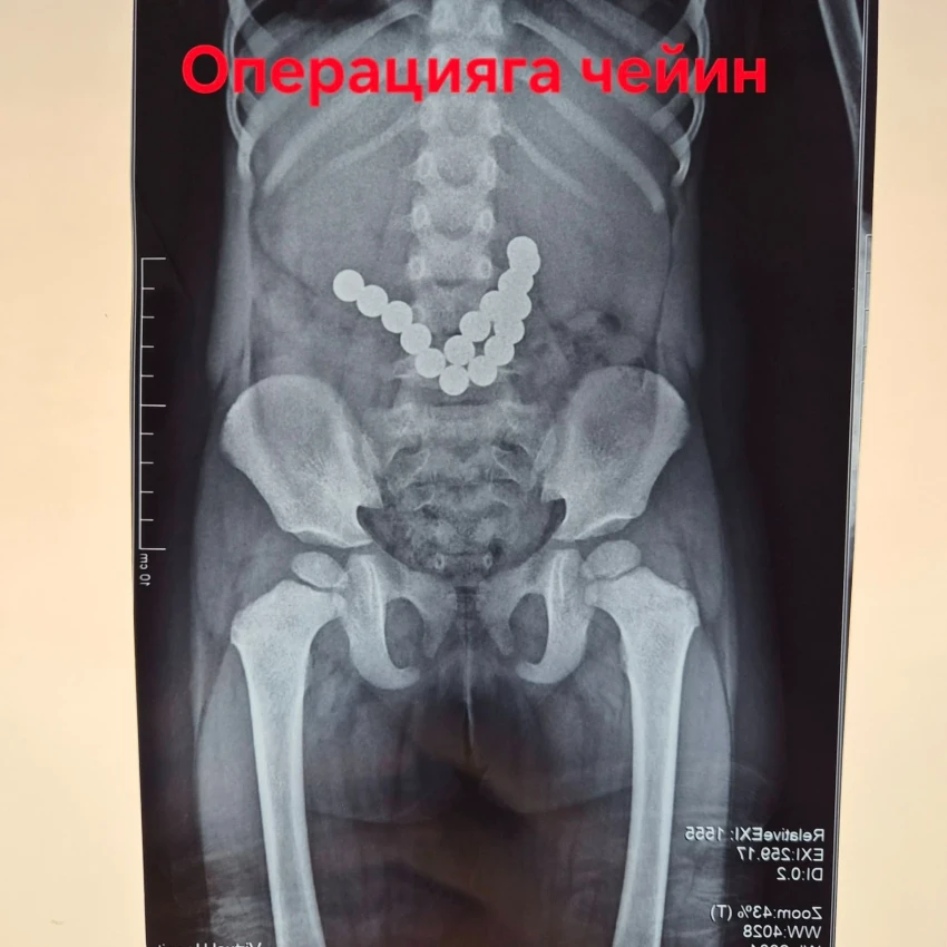 In Osh, a two-year-old child underwent emergency surgery to remove 17 swallowed magnets