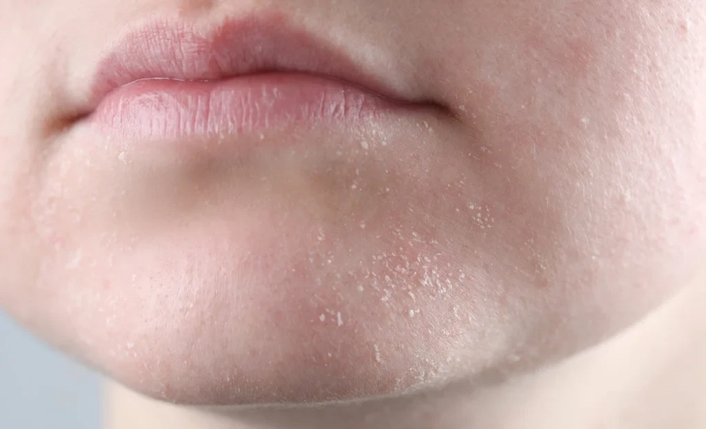 The doctor talked about diseases associated with dry skin