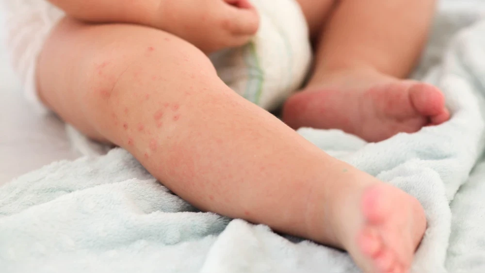 The majority of measles cases in Kazakhstan are among children under five years old, - Ministry of Health