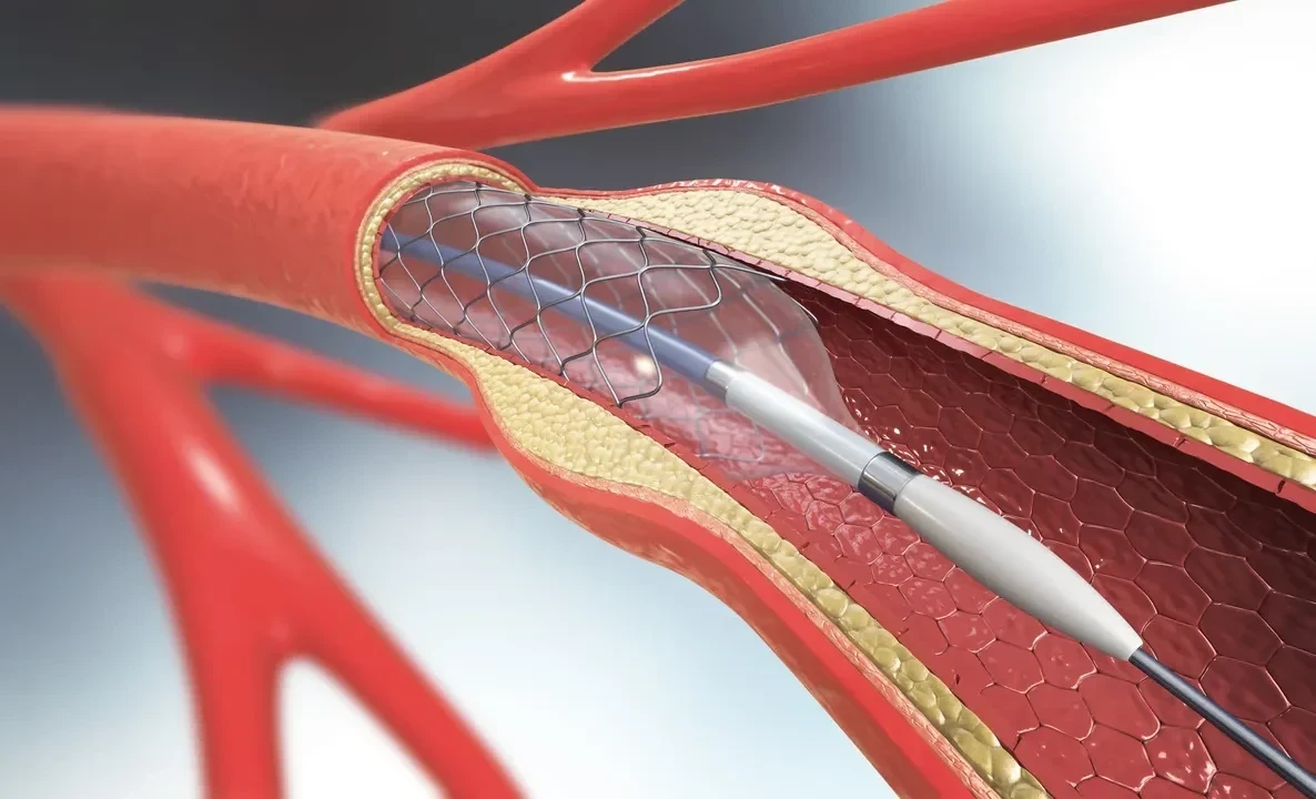 Депутат поинтересовался борьбой Минздрава с сердечными заболеваниями